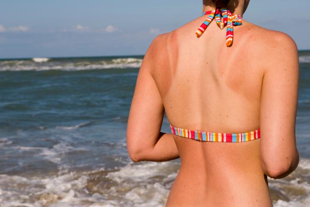 Young woman with sunburn at beach, looking toward horizon