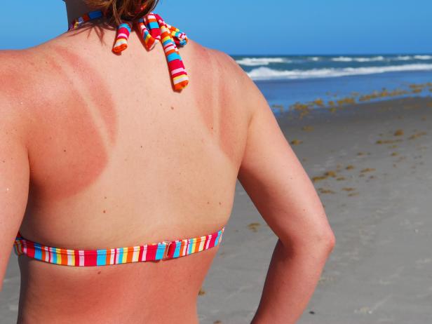 Sunburned woman's back at the beach