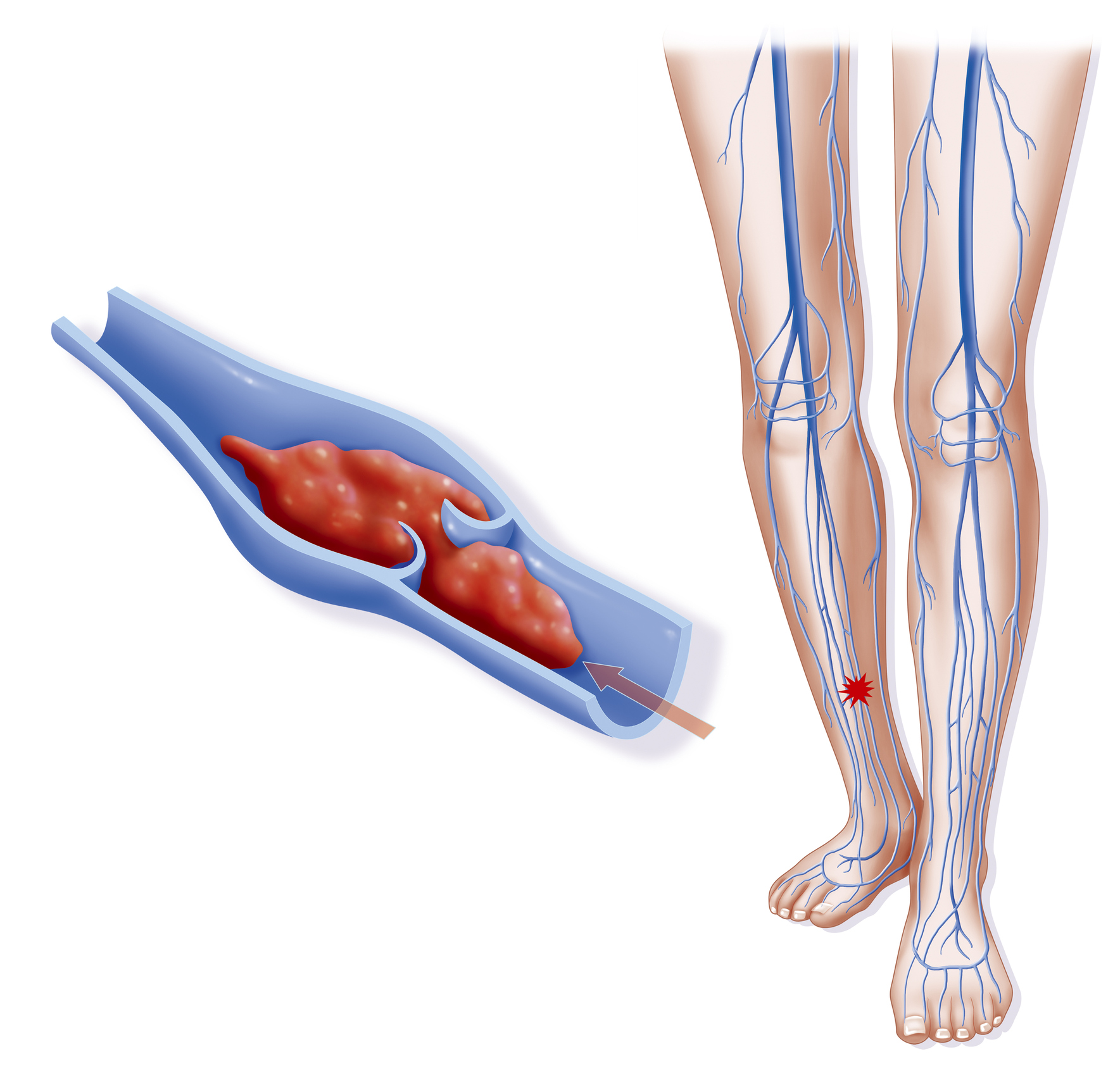 Air Travel Compression Socks to Reduce Swelling and Discompfort